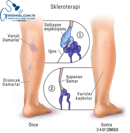 Köpük skleroterapi, varislerin tedavisinde kullanılan etkili bir yöntemdir. Bu yöntemde,