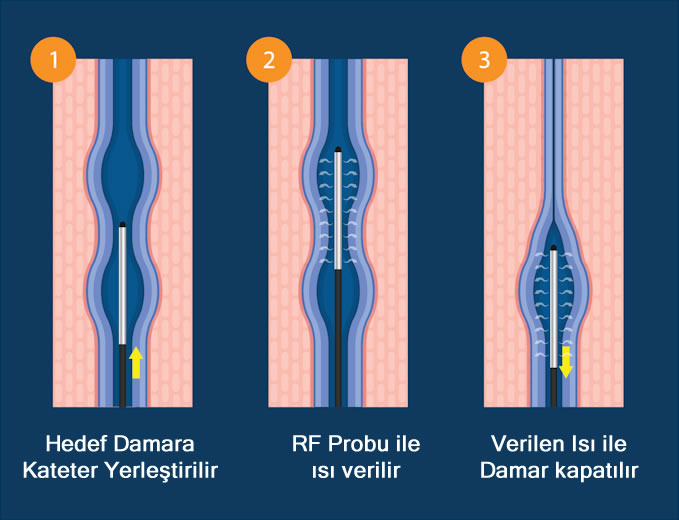 Varisler, genellikle bacaklarda beliren